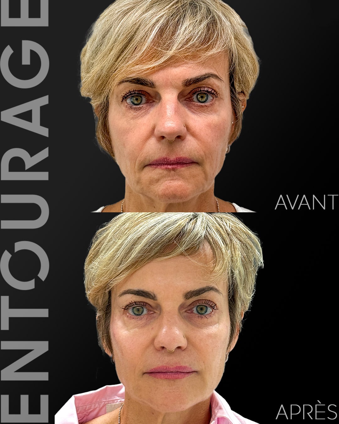 Traitement d'acide hyaluronique visage à Lausanne. Avant/Après médecine esthétique